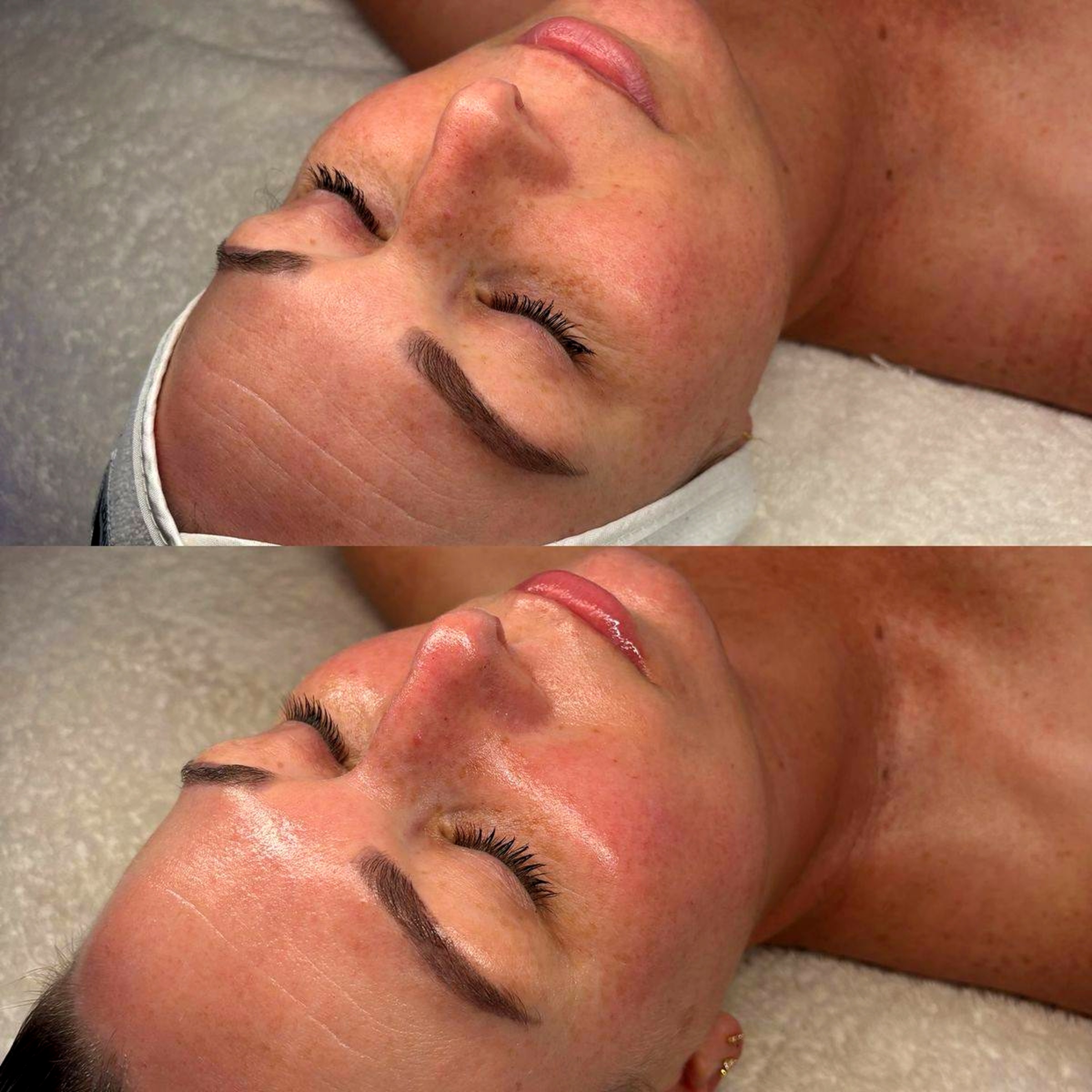 Facial treatment before and after result