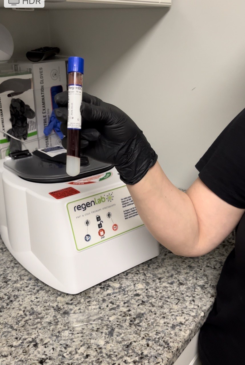 Microneedling with PRP treatment at SBW Beauty