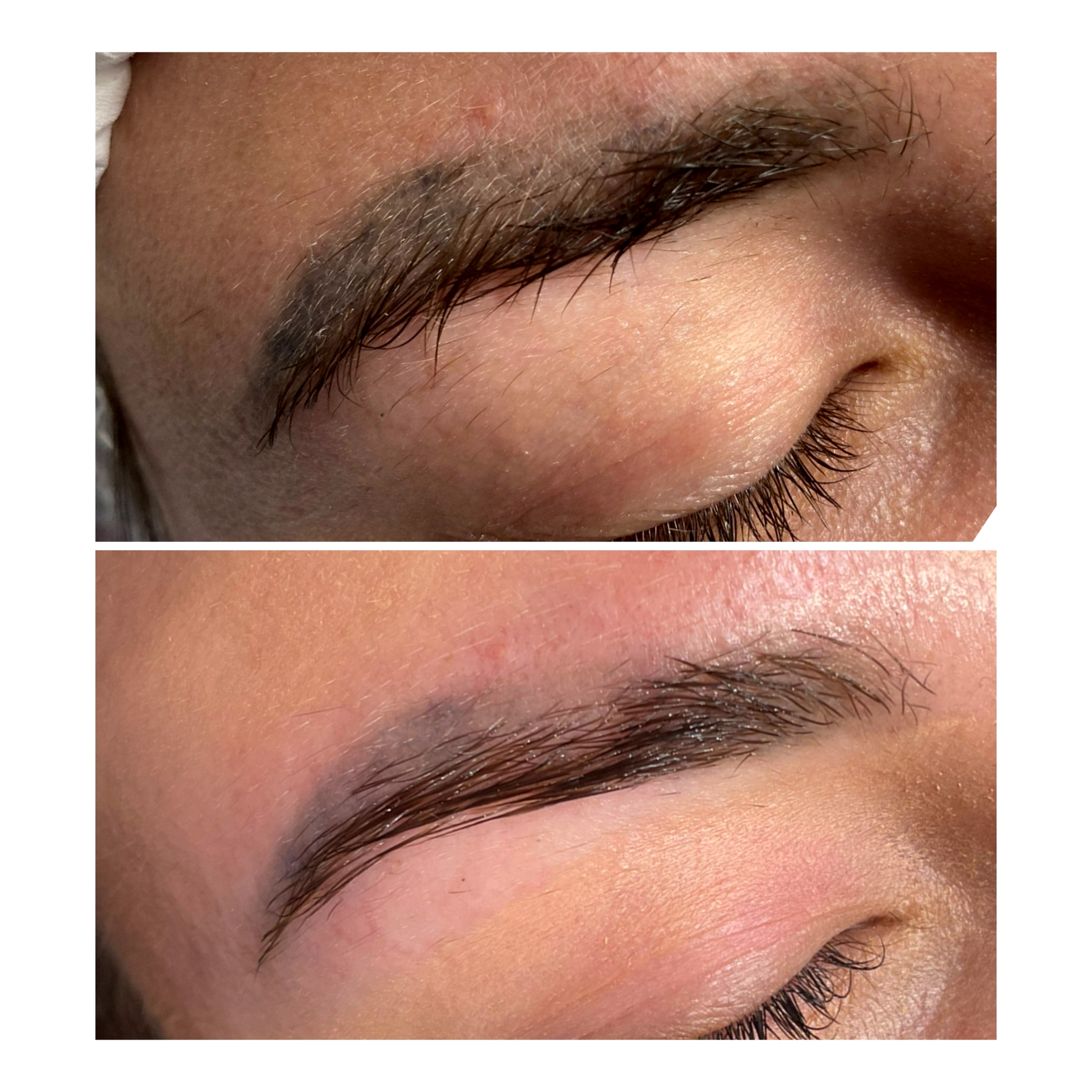 Permanent makeup removal result at SBW Beauty
